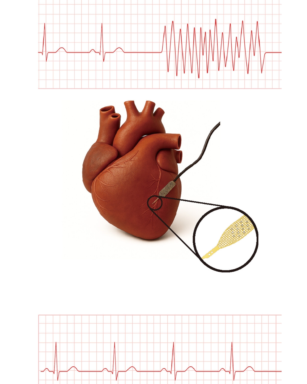 Illustration of a human heart model with a thin wired implant attached, magnified in a circle to show a yellow mesh-like electrode