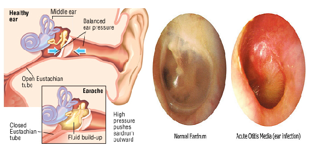 Буллезный отит фото уха An ear for innovation