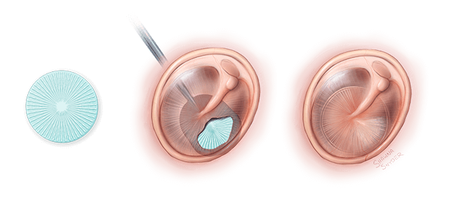 This illustration shows how the PhonoGraft leads to functional and morphological regeneration of the tympanic membrane.