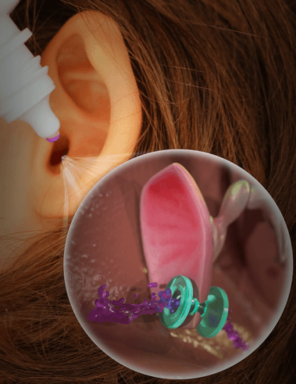 耳管などの体液輸送デバイスを最適化するための青写真を描く(Creating a blueprint for optimized ear tubes and other implantable fluid-transporting devices)