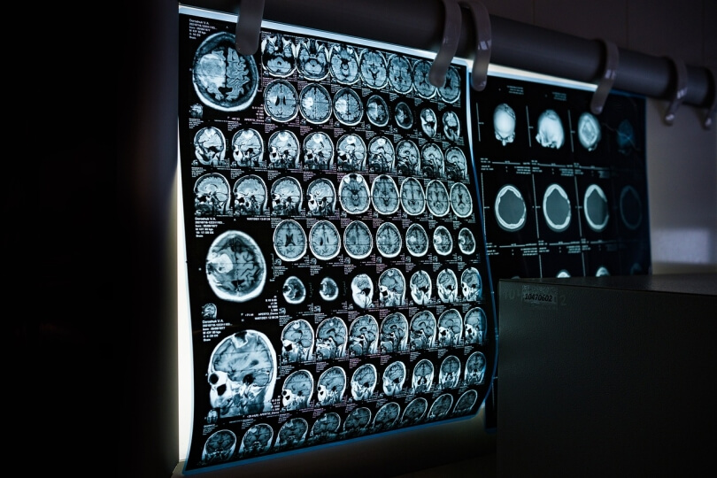 Photo of brain scan images on a computer screen