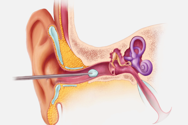 This image shows the noninvasive process by which the PhonoGraft is installed through the ear canal.