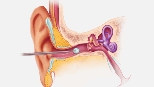 This image shows the noninvasive process by which the PhonoGraft is installed through the ear canal.