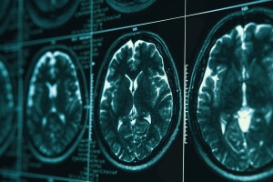stock image of brain MRI