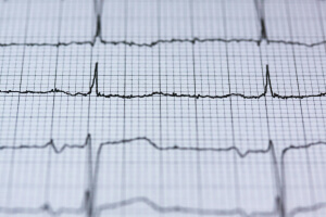 Close-up of an electrocardiogram (ECG) printout showing several horizontal traces of heartbeats as jagged black lines on a fine grid of light gray squares